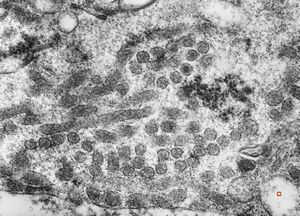 M,2y. | viral particles ? in hepatocyte M,2y. | viral particles ? in hepatocyte